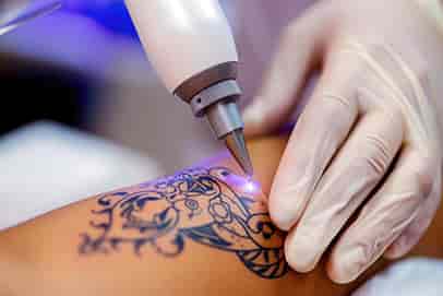 Lézeres tetoválás eltávolítás gyógyulási idő